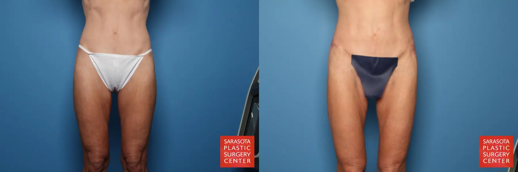 Thigh Lift: Patient 3 - Before and After  