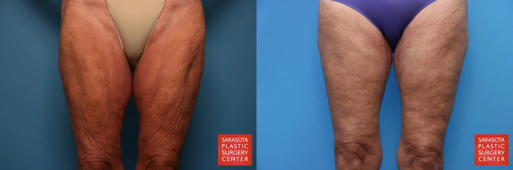 Thigh Lift: Patient 5 - Before and After  