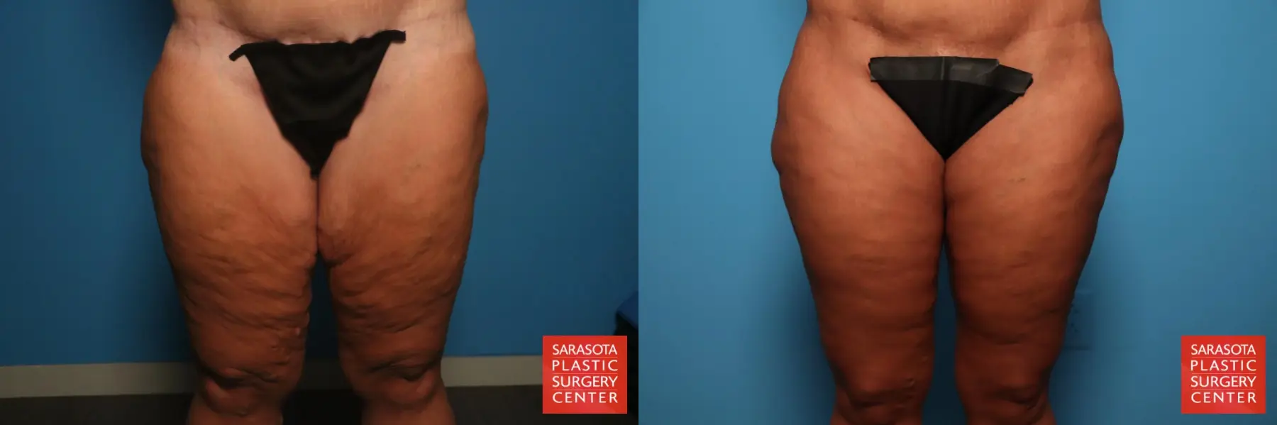 Thigh Lift: Patient 6 - Before and After  