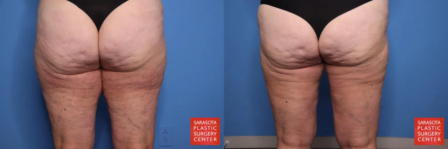 Thigh Lift: Patient 4 - Before and After 6