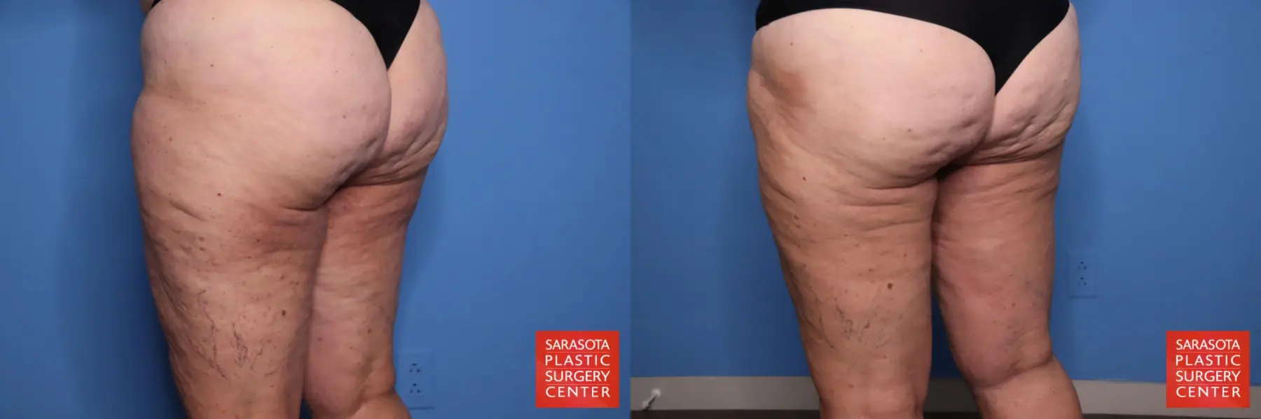 Thigh Lift: Patient 4 - Before and After 5