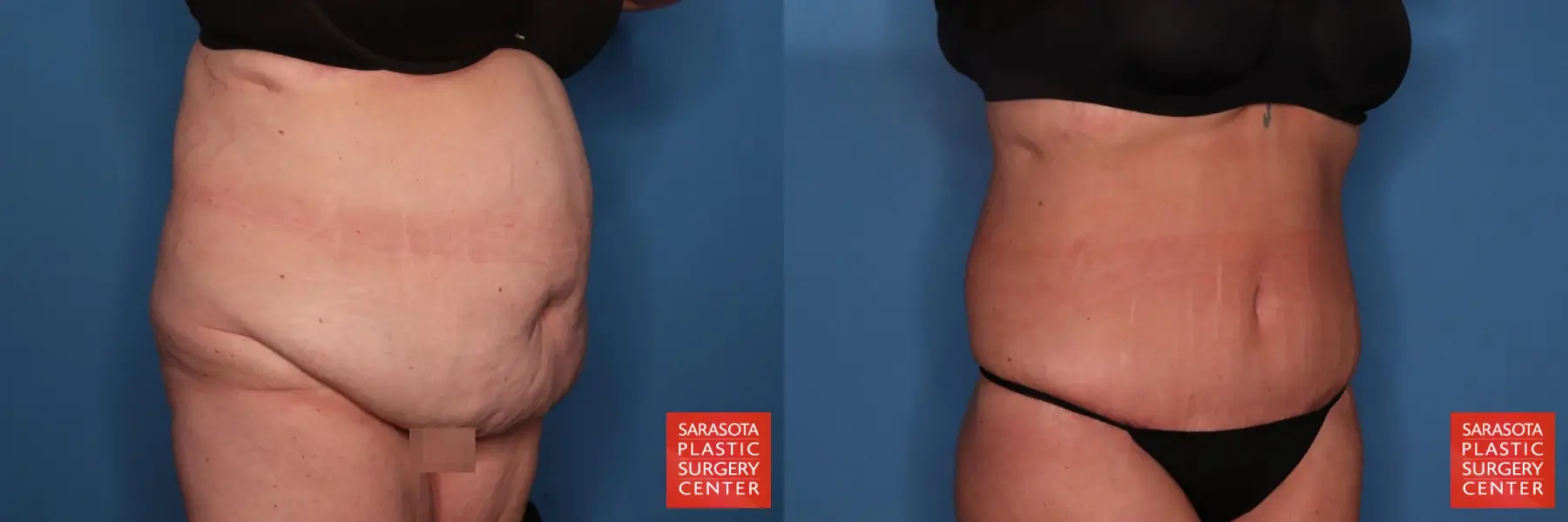 Tummy Tuck: Patient 99 - Before and After 5