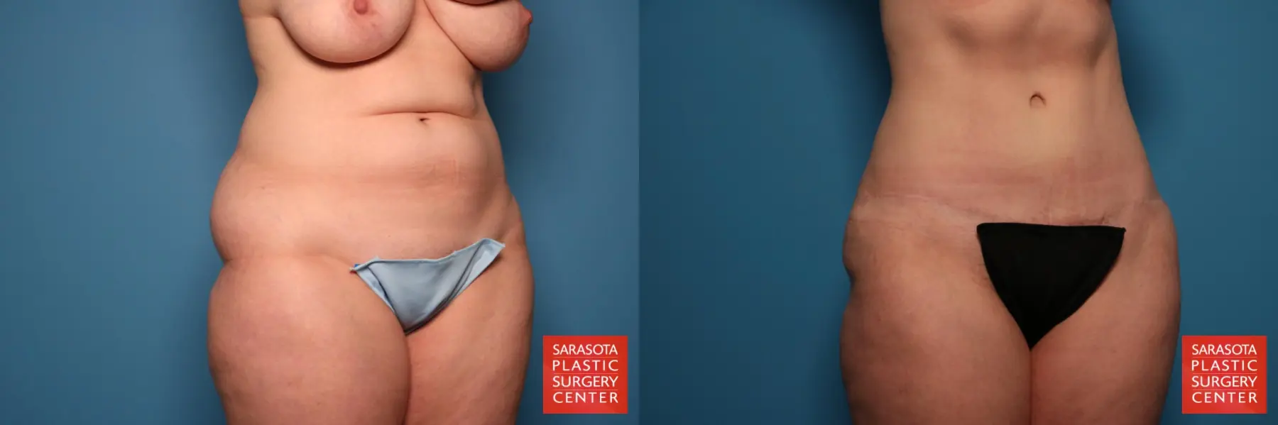 Tummy Tuck: Patient 109 - Before and After 5