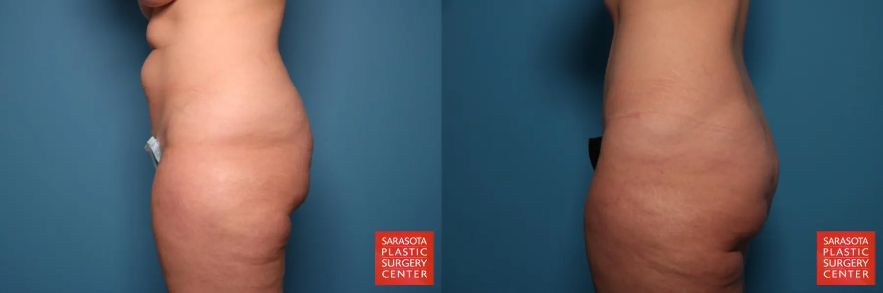 Tummy Tuck: Patient 109 - Before and After 3