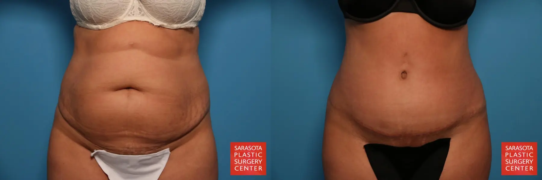 Tummy Tuck: Patient 82 - Before and After  