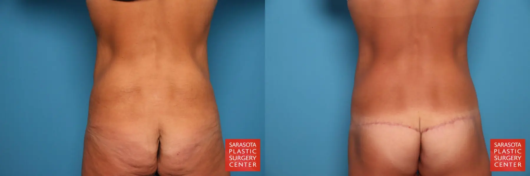 Tummy Tuck: Patient 104 - Before and After 5