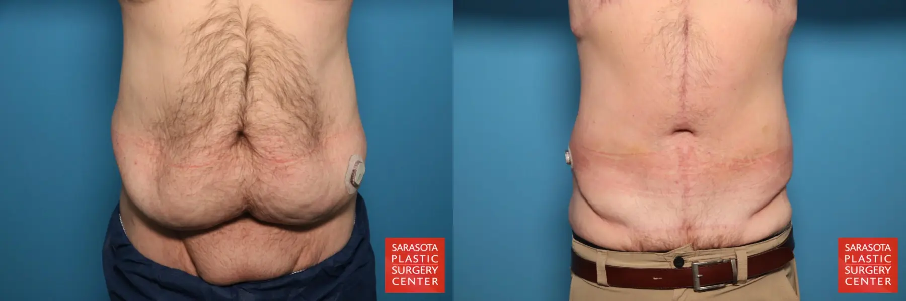 Tummy Tuck: Patient 96 - Before and After  