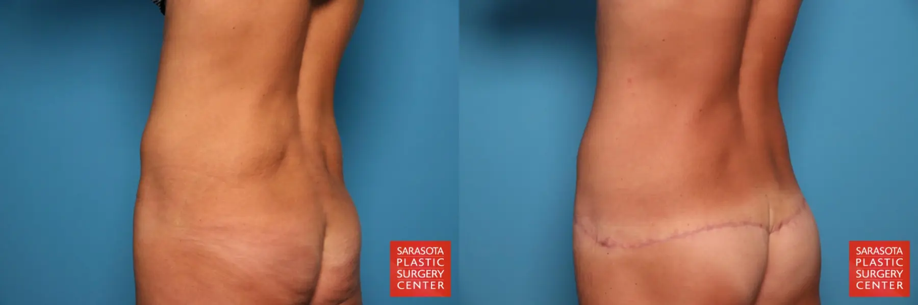 Tummy Tuck: Patient 104 - Before and After 4