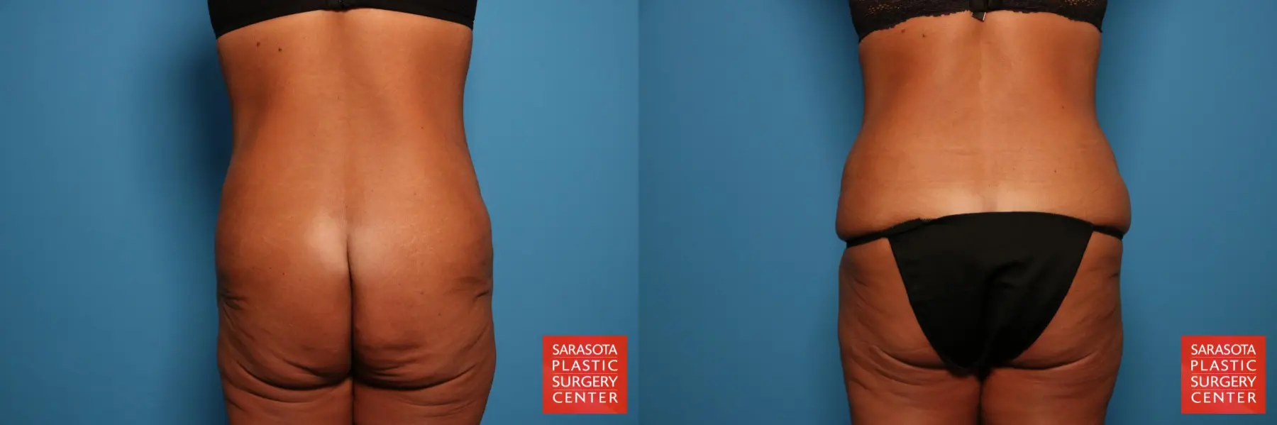 Tummy Tuck: Patient 74 - Before and After 5