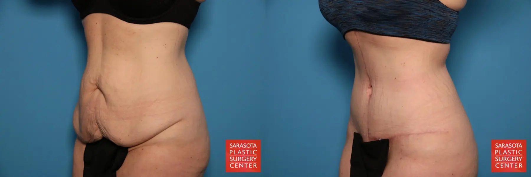Tummy Tuck: Patient 90 - Before and After 2