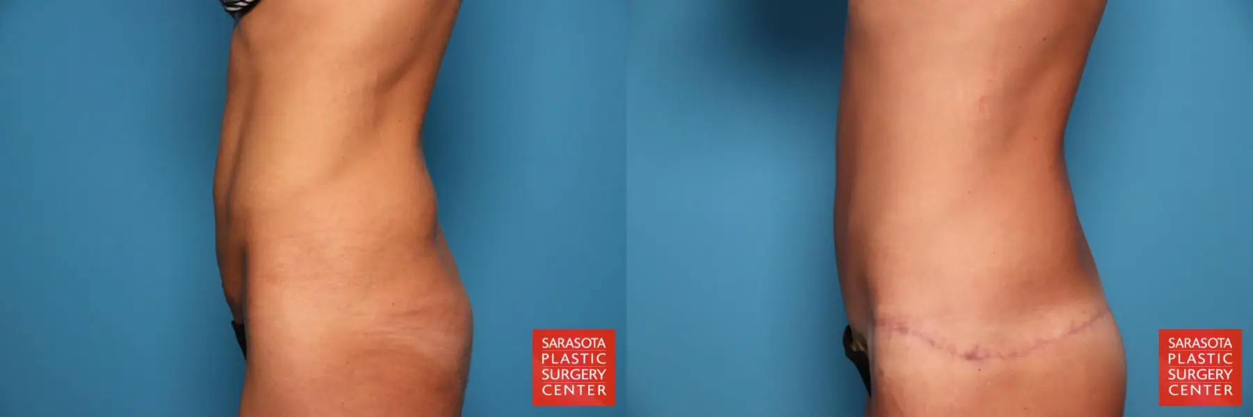 Tummy Tuck: Patient 104 - Before and After 3