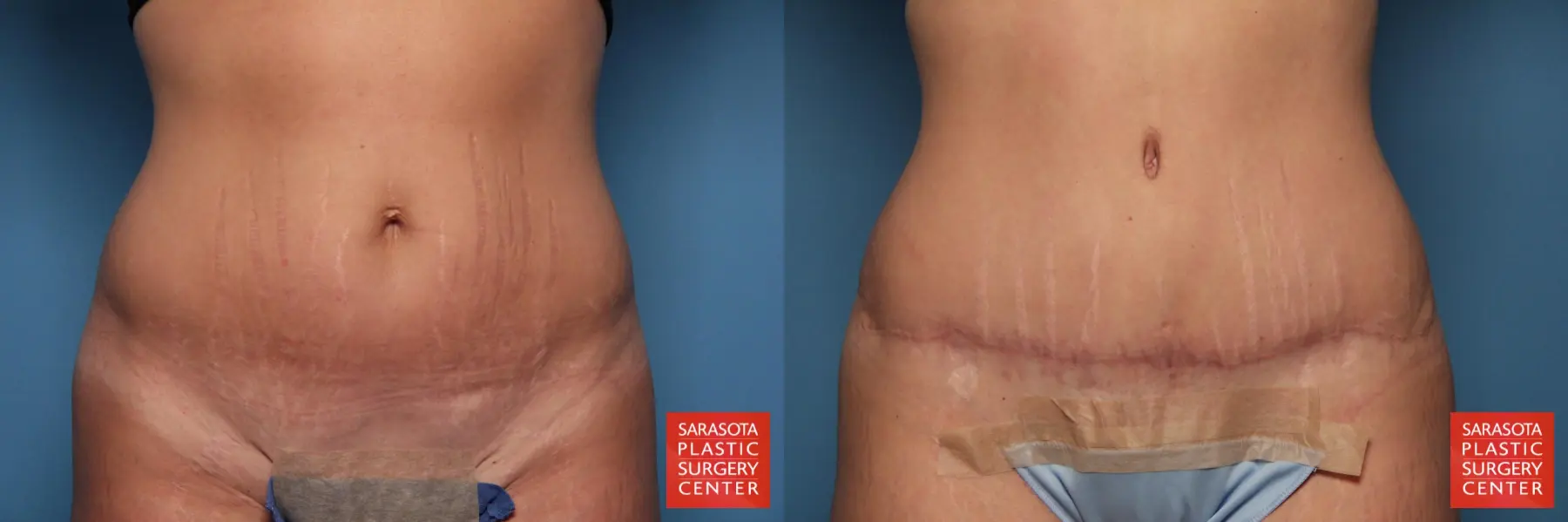 Tummy Tuck: Patient 83 - Before and After  