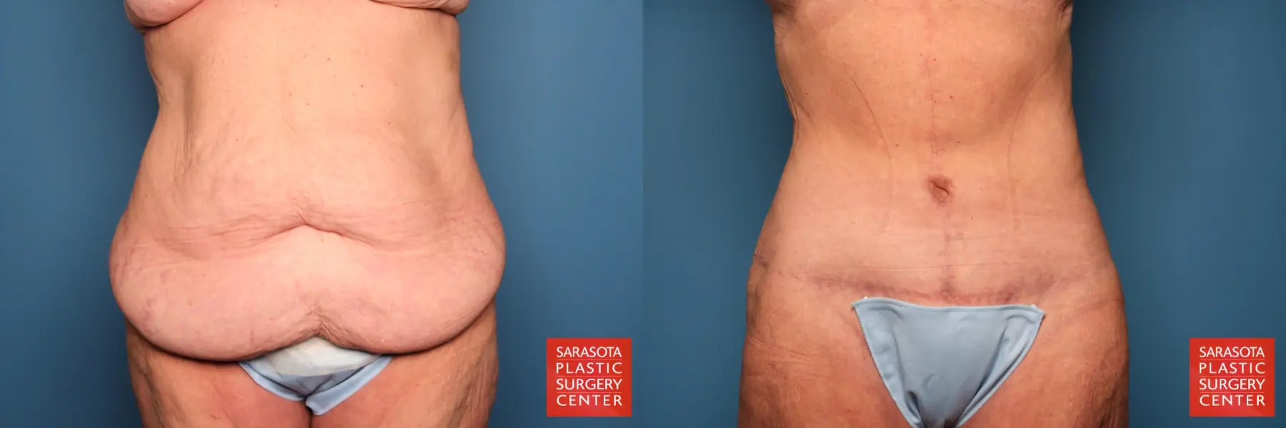 Tummy Tuck: Patient 92 - Before and After  