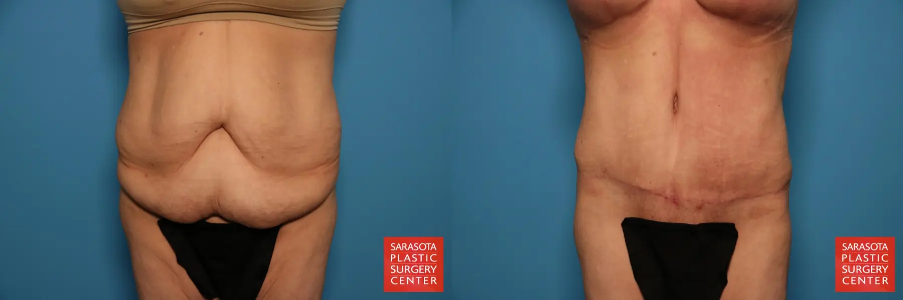 Tummy Tuck: Patient 94 - Before and After  