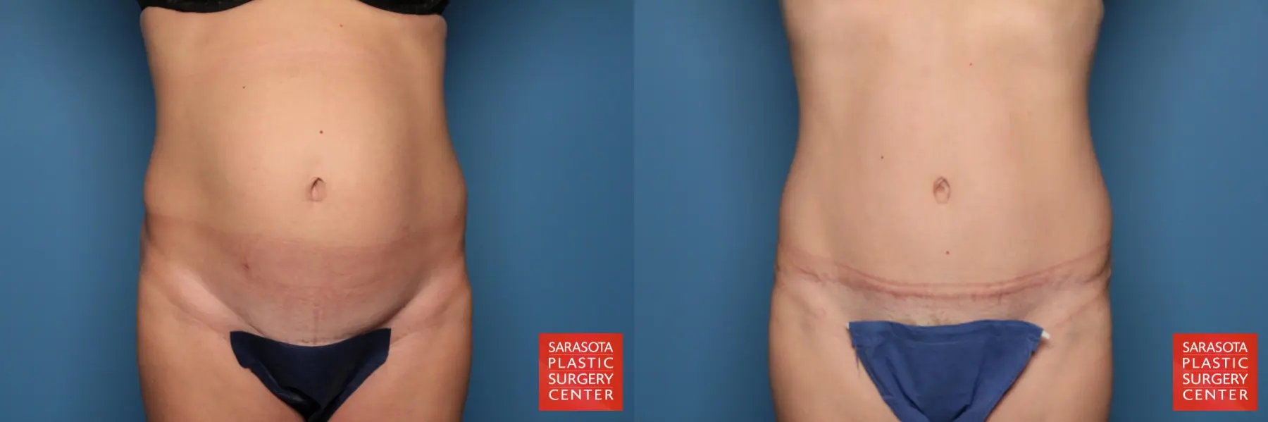 Tummy Tuck: Patient 13 - Before and After  