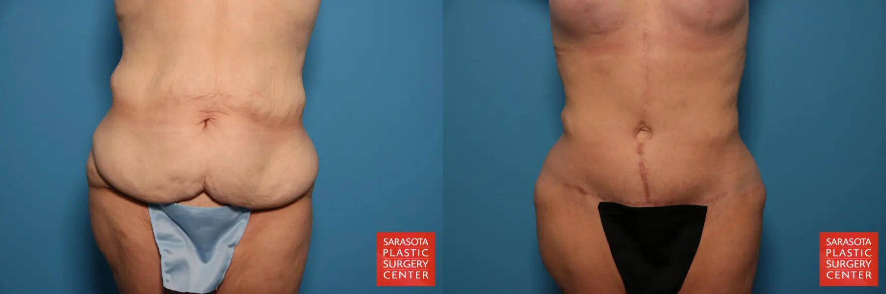 Tummy Tuck: Patient 93 - Before and After  