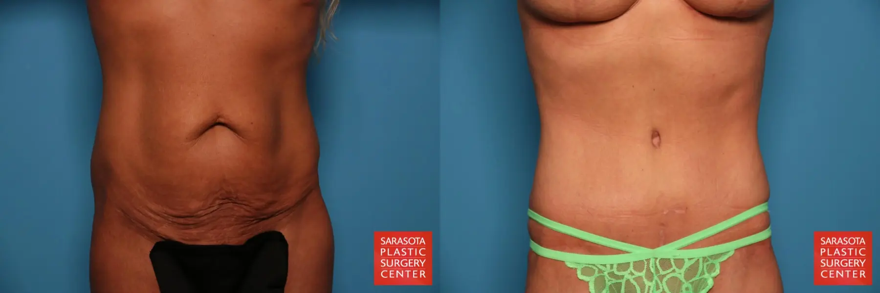 Tummy Tuck: Patient 7 - Before and After  