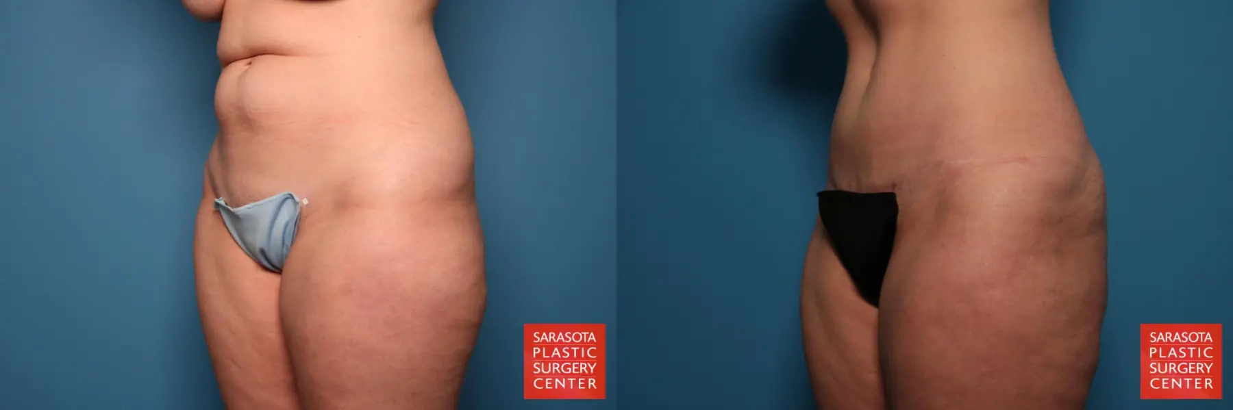 Tummy Tuck: Patient 109 - Before and After 2