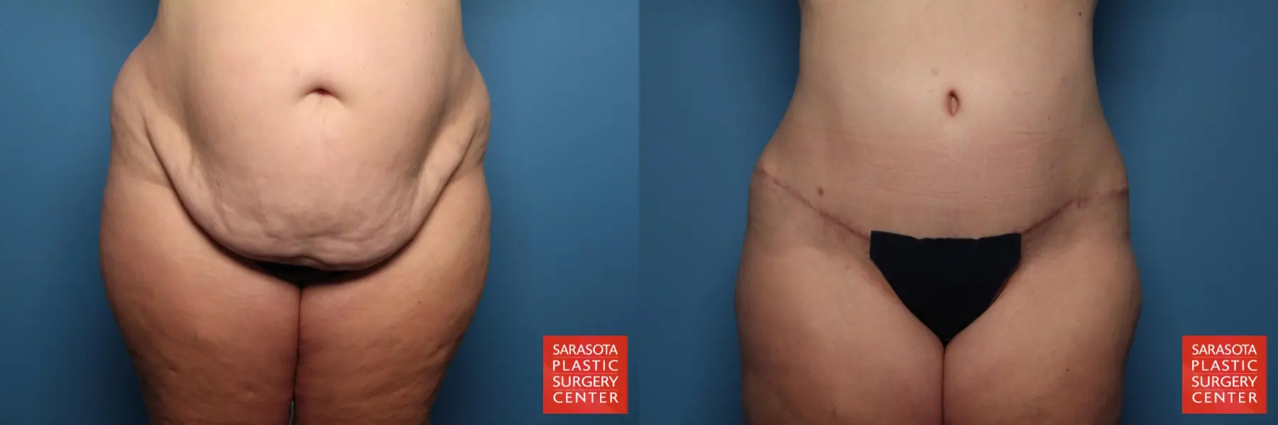 Tummy Tuck: Patient 79 - Before and After  