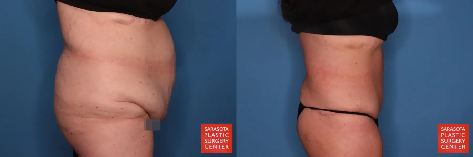 Tummy Tuck: Patient 99 - Before and After 4