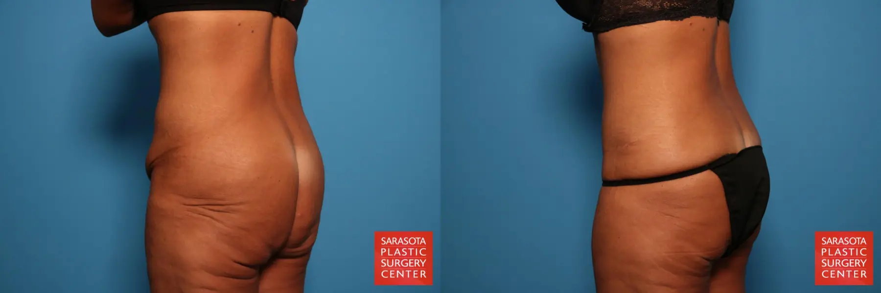 Tummy Tuck: Patient 74 - Before and After 4