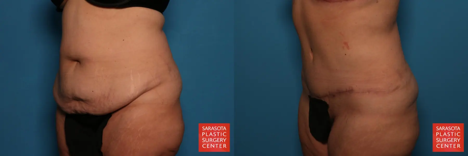 Tummy Tuck: Patient 25 - Before and After 2