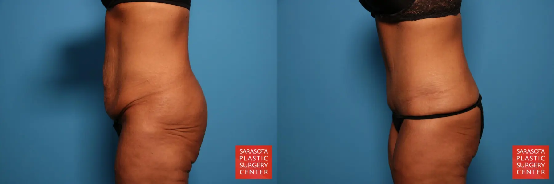 Tummy Tuck: Patient 74 - Before and After 3