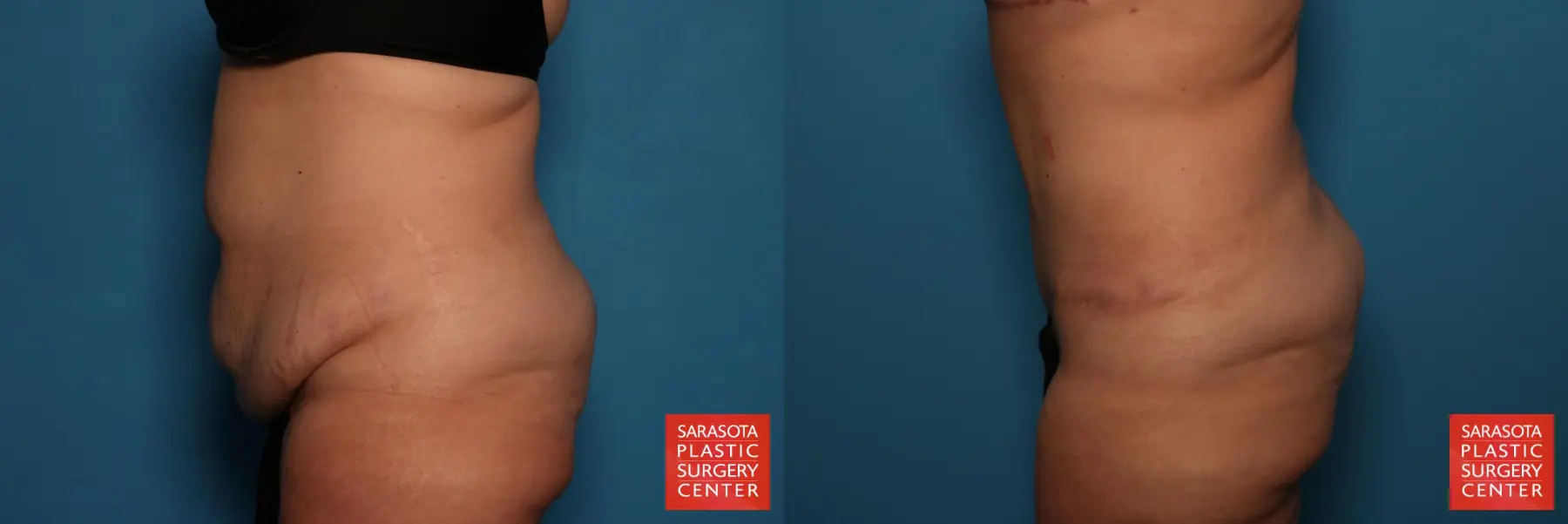 Tummy Tuck: Patient 25 - Before and After 3