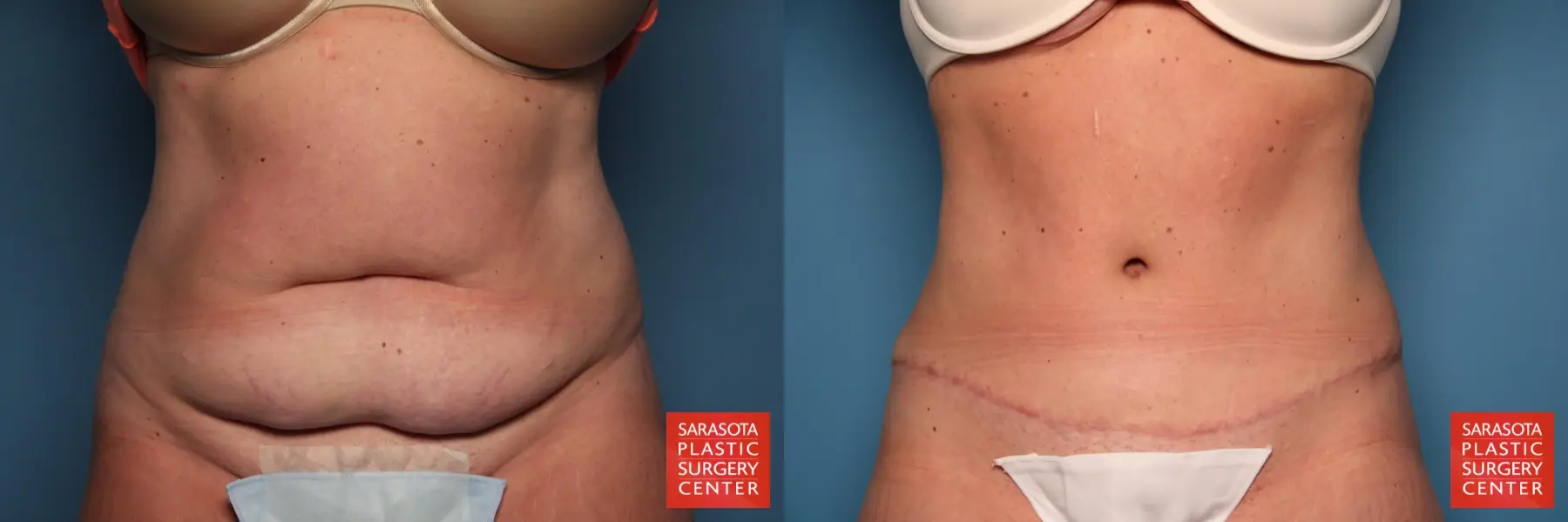 Tummy Tuck: Patient 3 - Before and After  