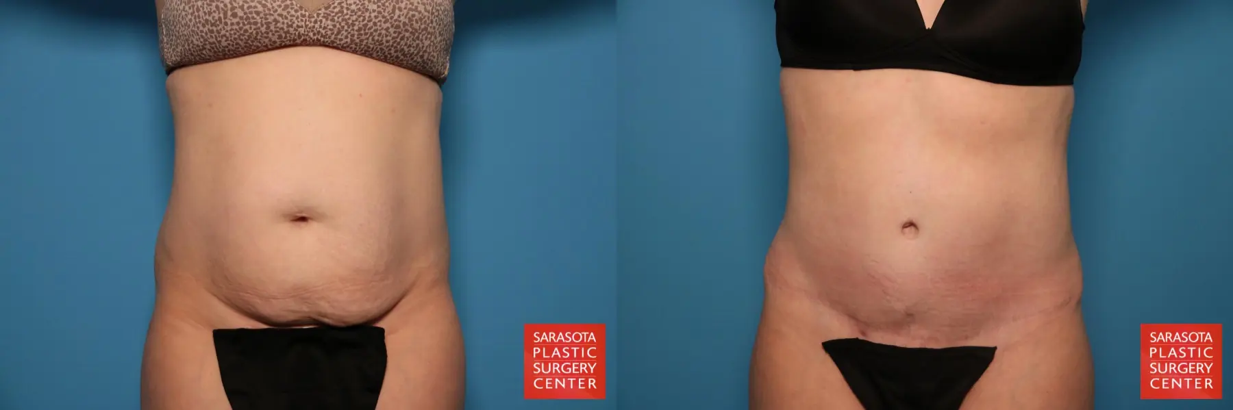 Tummy Tuck: Patient 81 - Before and After  