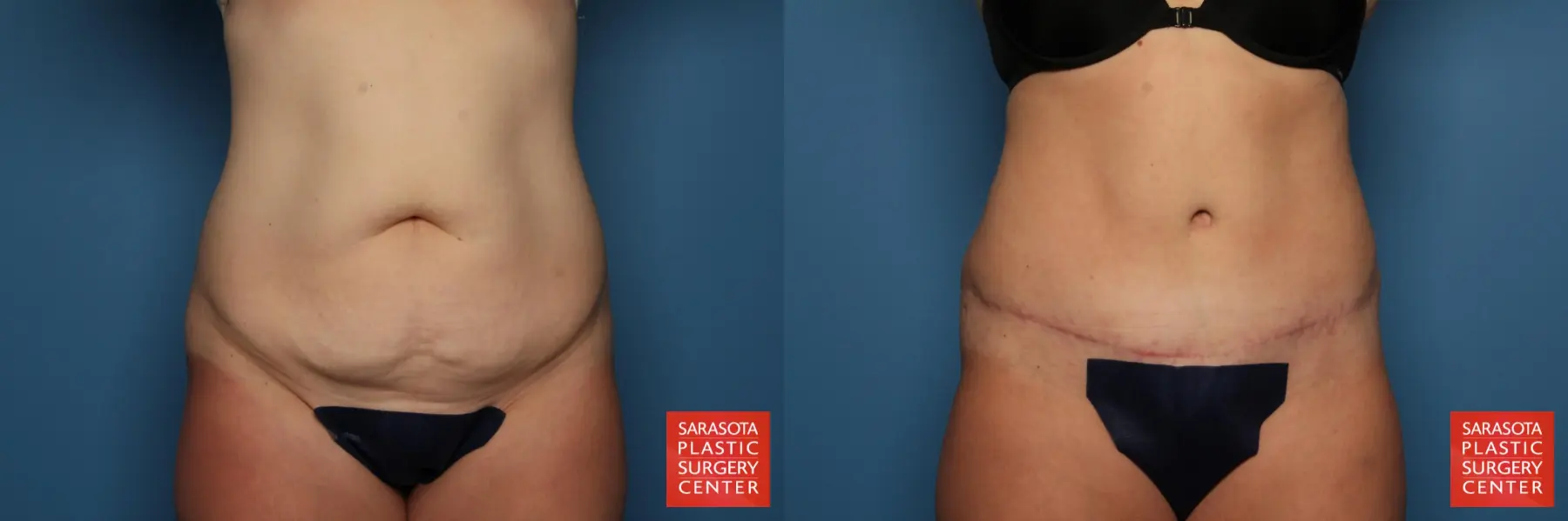 Tummy Tuck: Patient 17 - Before and After  