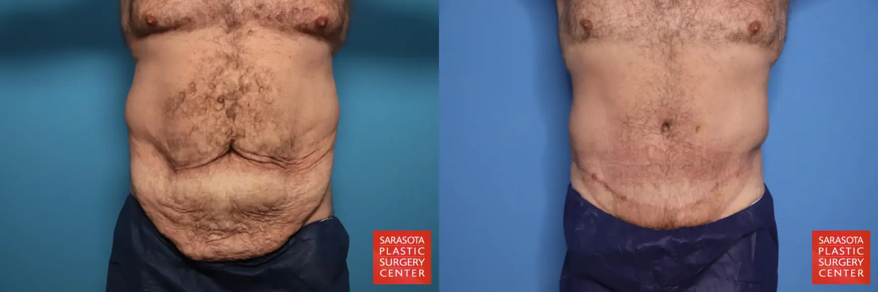 Tummy Tuck: Patient 95 - Before and After  