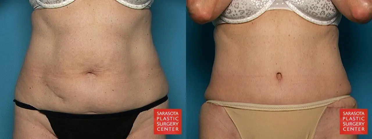 Tummy Tuck: Patient 10 - Before and After  