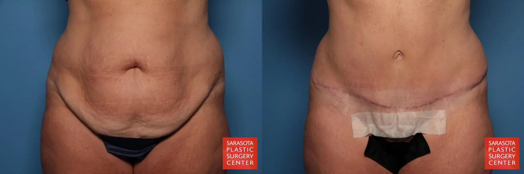 Tummy Tuck: Patient 45 - Before and After  