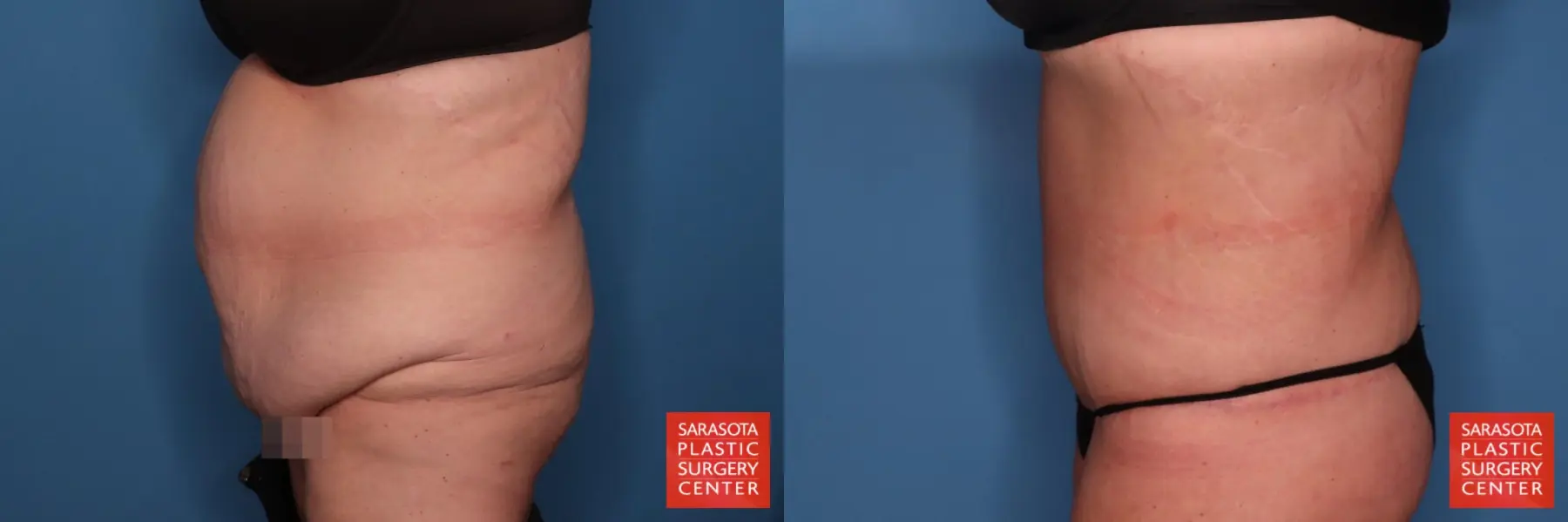 Tummy Tuck: Patient 99 - Before and After 3