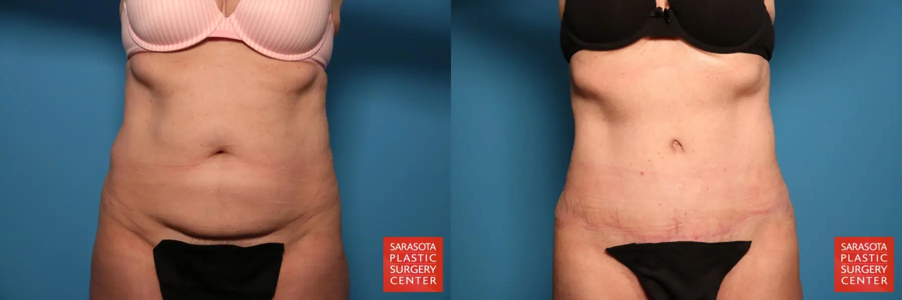 Tummy Tuck: Patient 84 - Before and After  