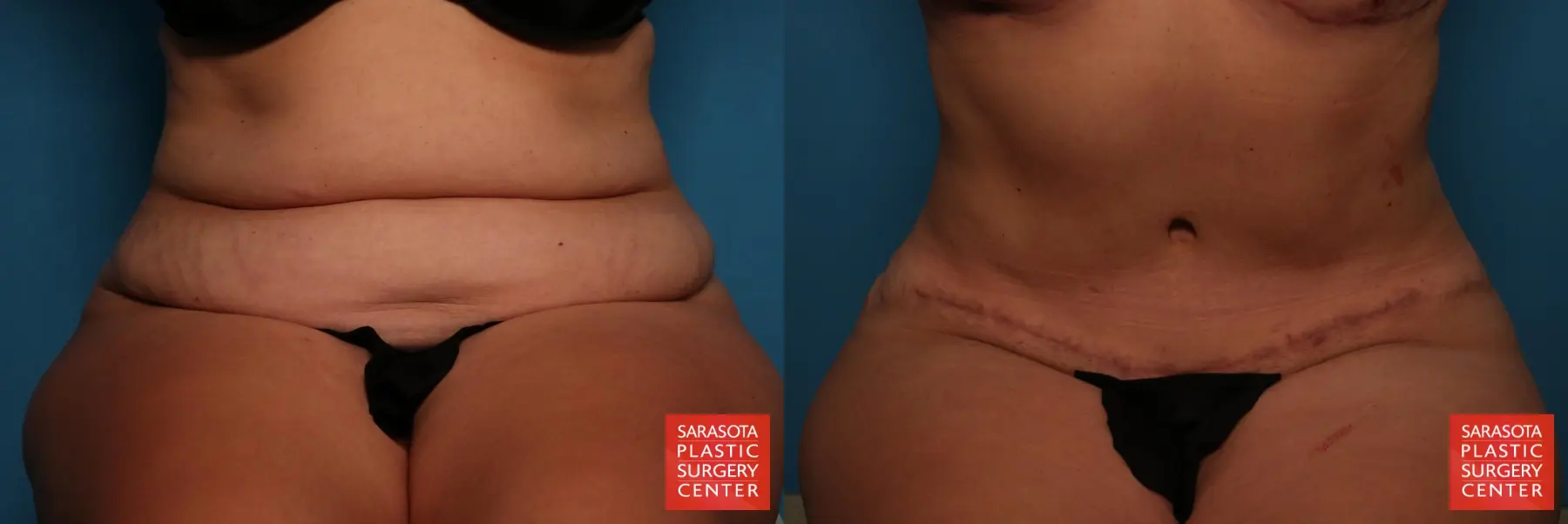 Tummy Tuck: Patient 25 - Before and After 4