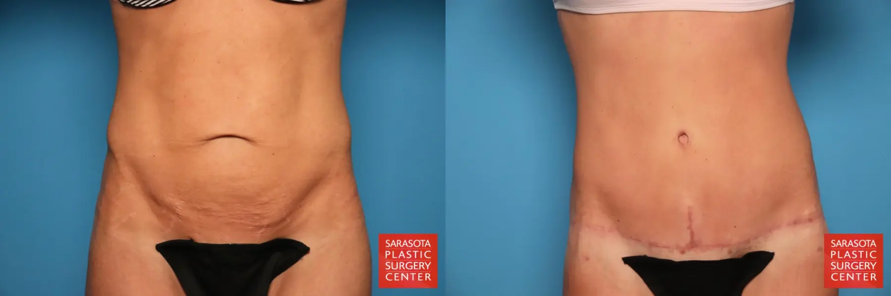 Tummy Tuck: Patient 104 - Before and After 1