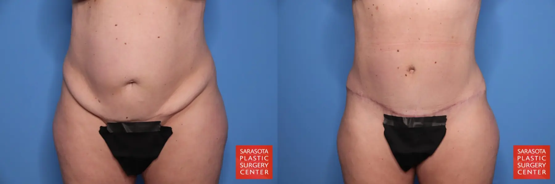 Tummy Tuck: Patient 85 - Before and After  