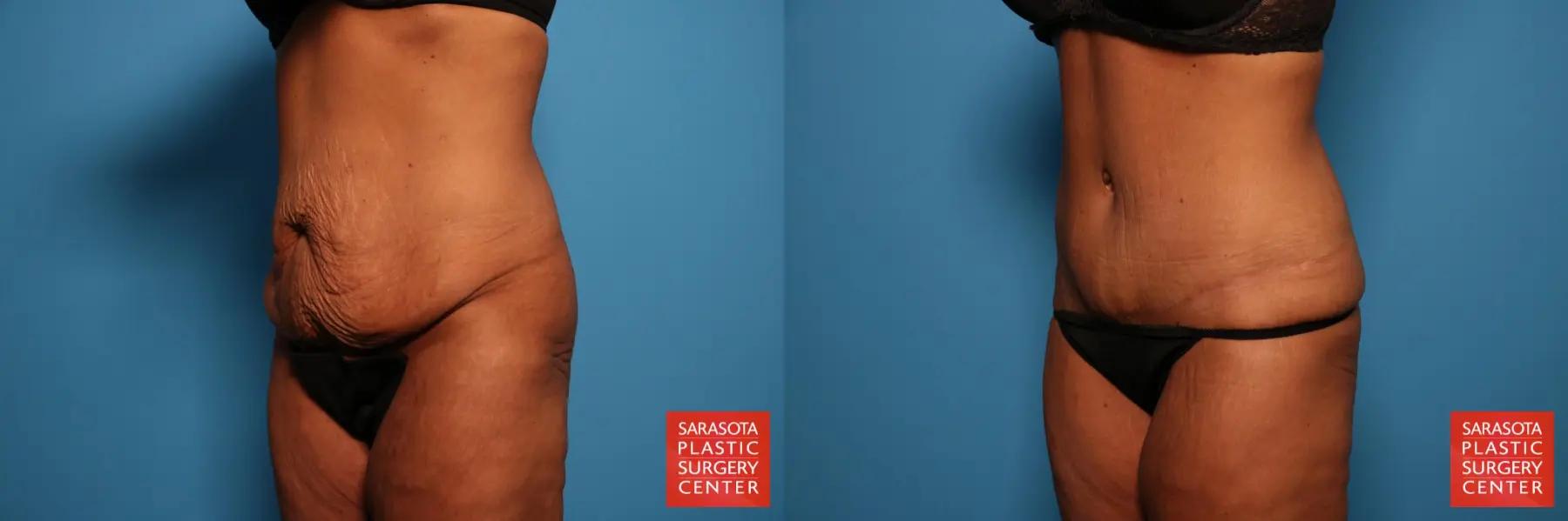 Tummy Tuck: Patient 74 - Before and After 2