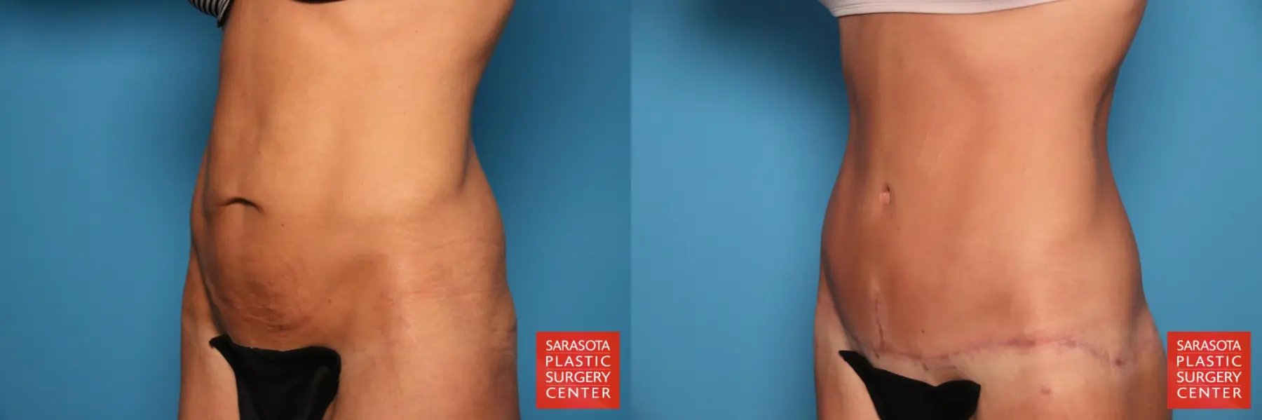 Tummy Tuck: Patient 104 - Before and After 2
