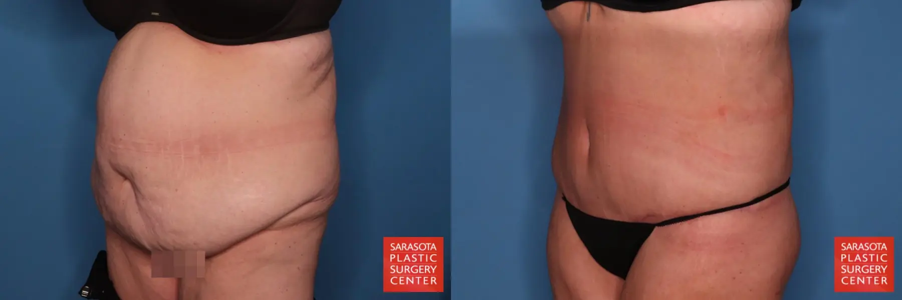 Tummy Tuck: Patient 99 - Before and After 2