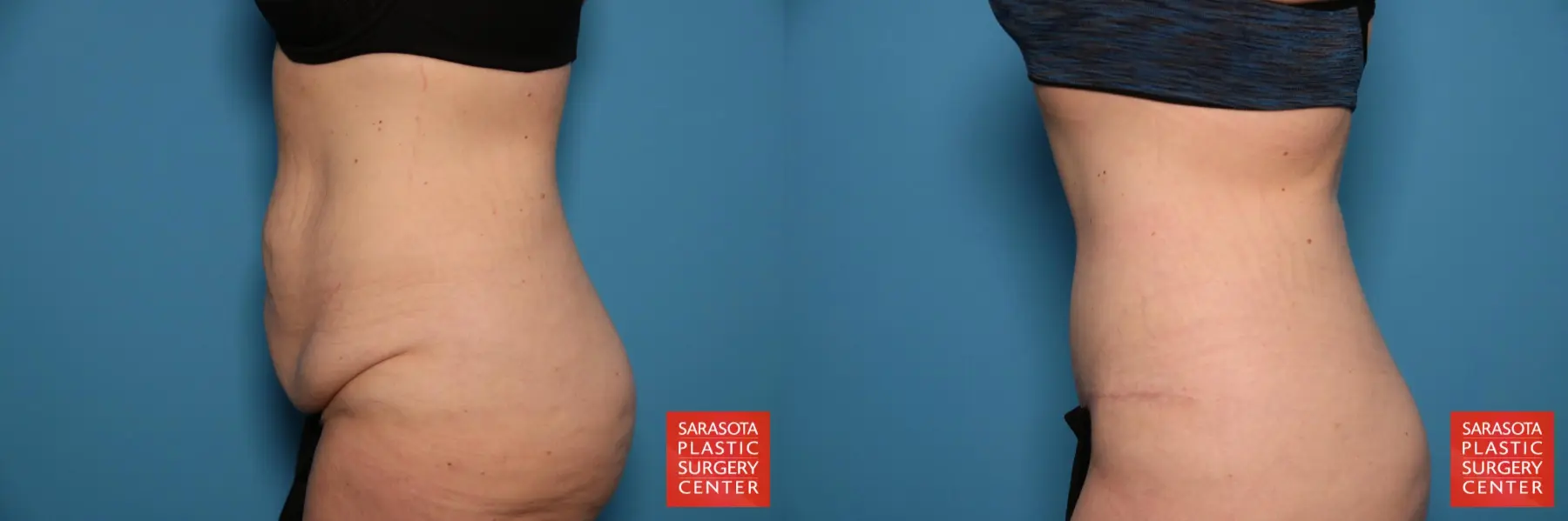 Tummy Tuck: Patient 90 - Before and After 3