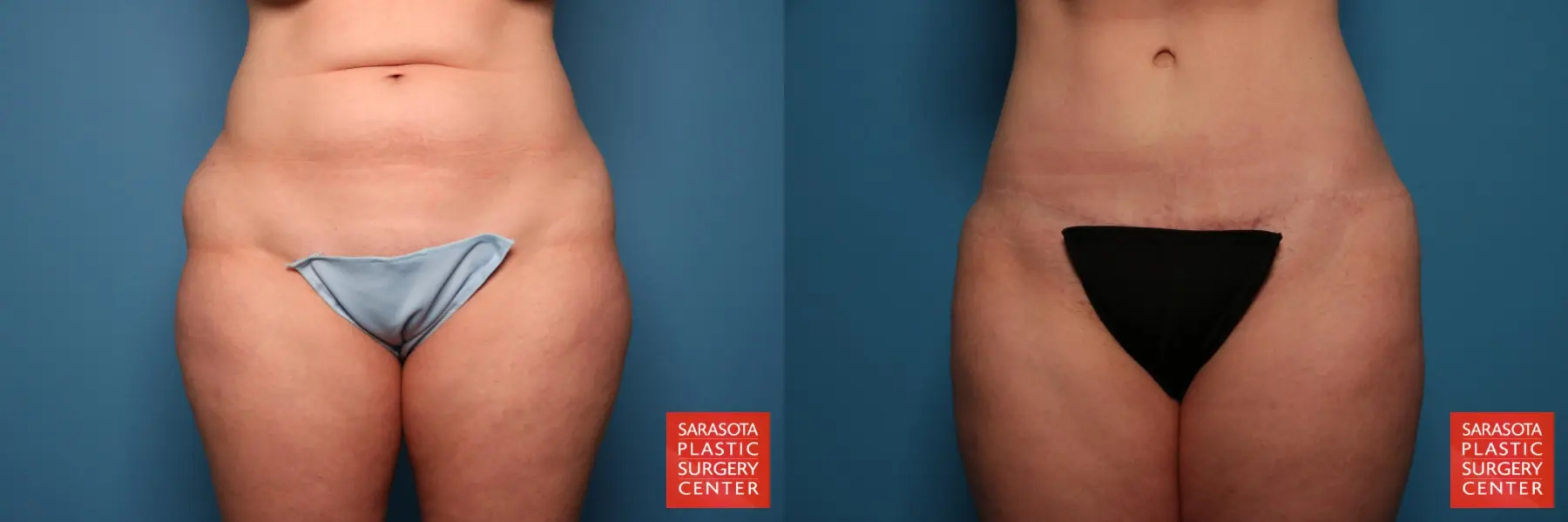 Tummy Tuck: Patient 109 - Before and After 1