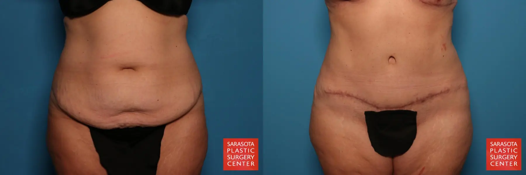 Tummy Tuck: Patient 25 - Before and After  