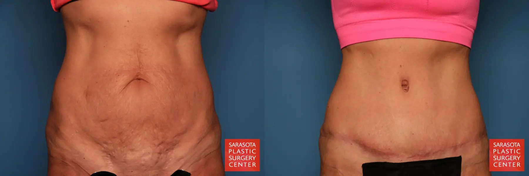 Tummy Tuck: Patient 20 - Before and After  
