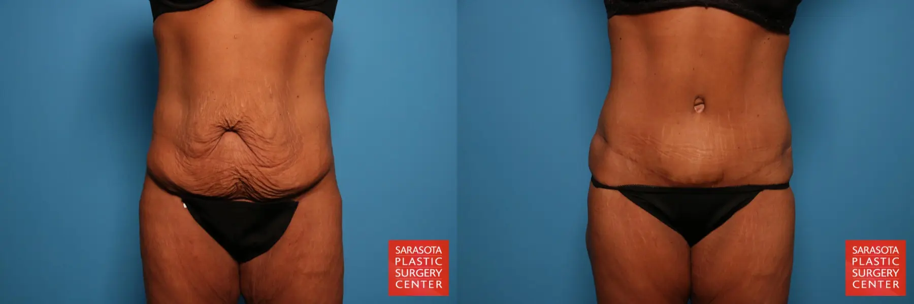 Tummy Tuck: Patient 74 - Before and After  