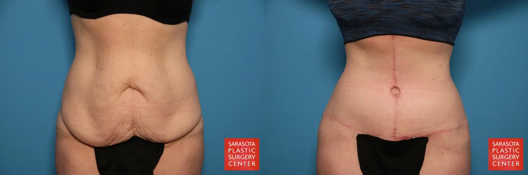 Tummy Tuck: Patient 90 - Before and After  