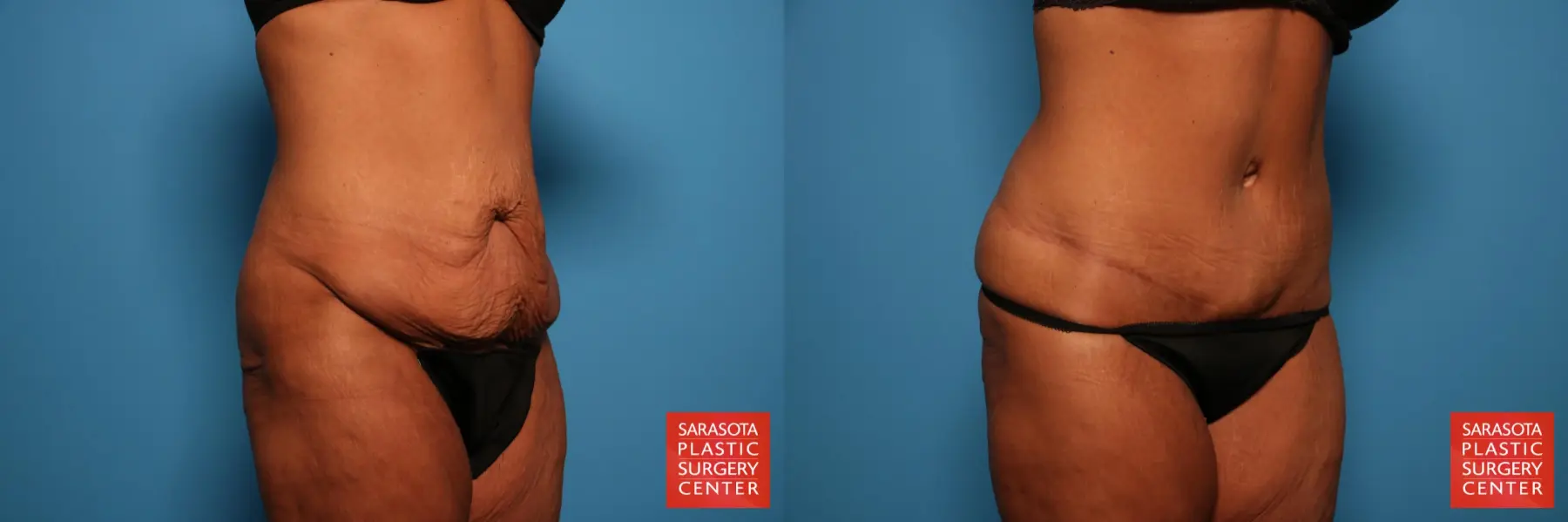 Tummy Tuck: Patient 74 - Before and After 7