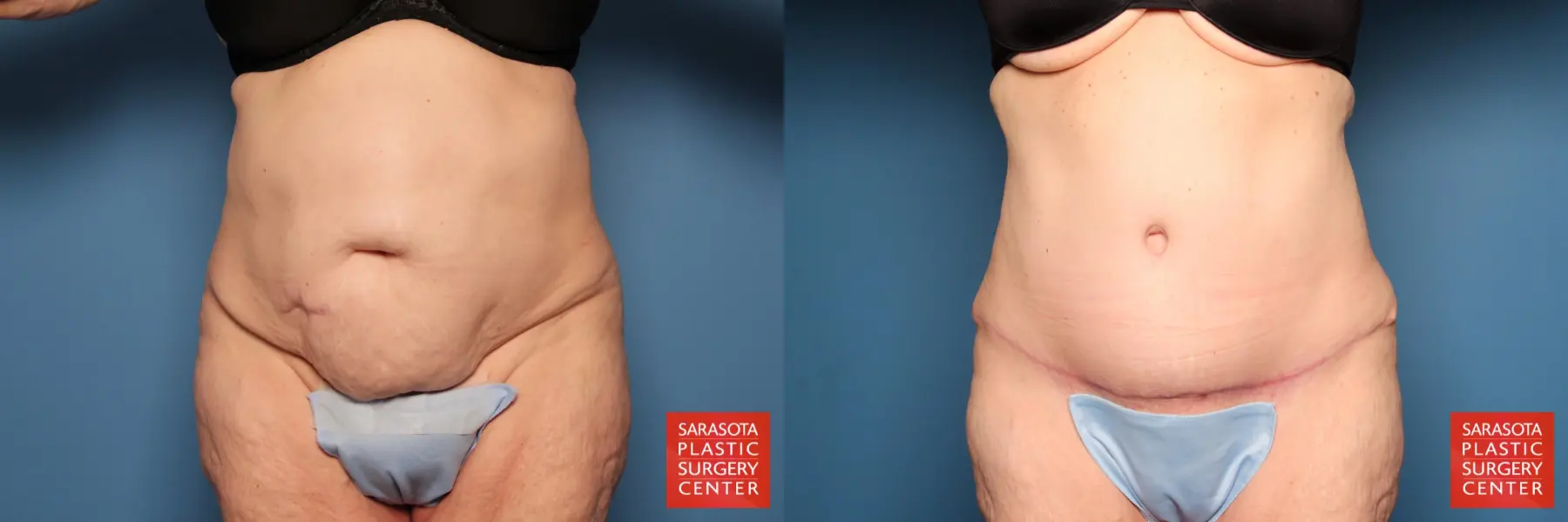 Tummy Tuck: Patient 73 - Before and After  